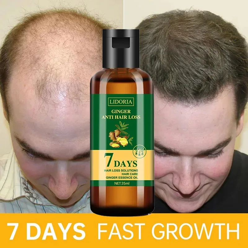 Hair Care Essential Oil Atomizing - เซรั่มปลูกผมร่วงน้ำมัน Essential ปลูกผมร่วงป้องกันการงอกของเส้นผมผลิตภัณฑ์ดูแลเส้นผมช่วยป้องกันศีรษะล้าน